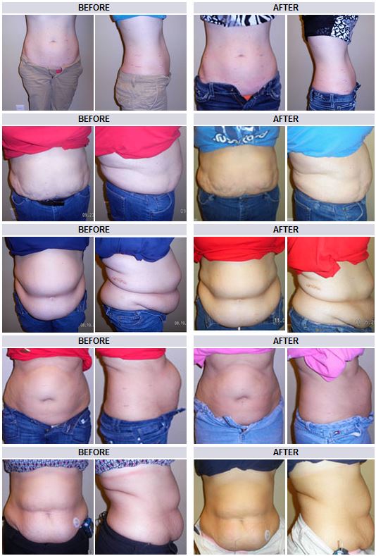 before and after the weight loss program in Leesburg, FL